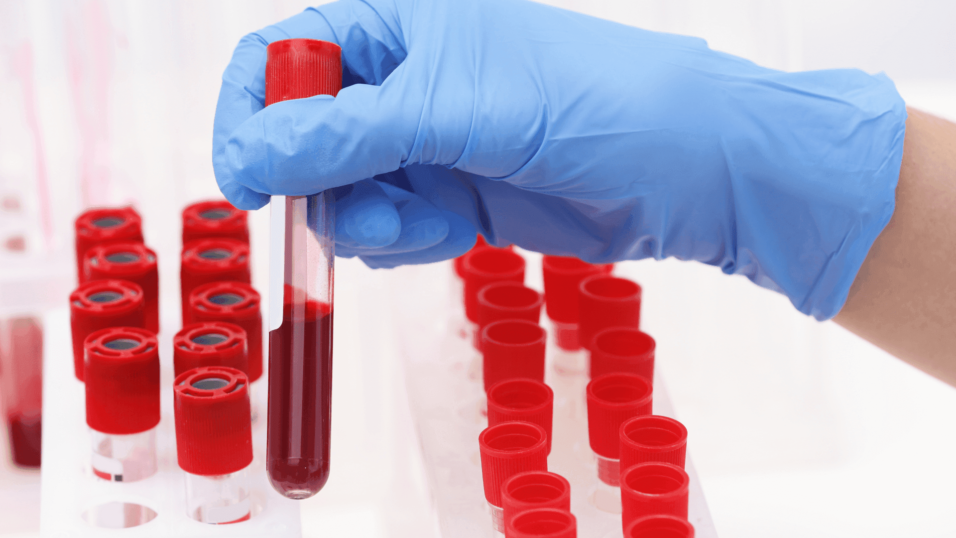 Mano con guanto blu che solleva una provetta piena di sangue da un portaprovette con tappi rossi