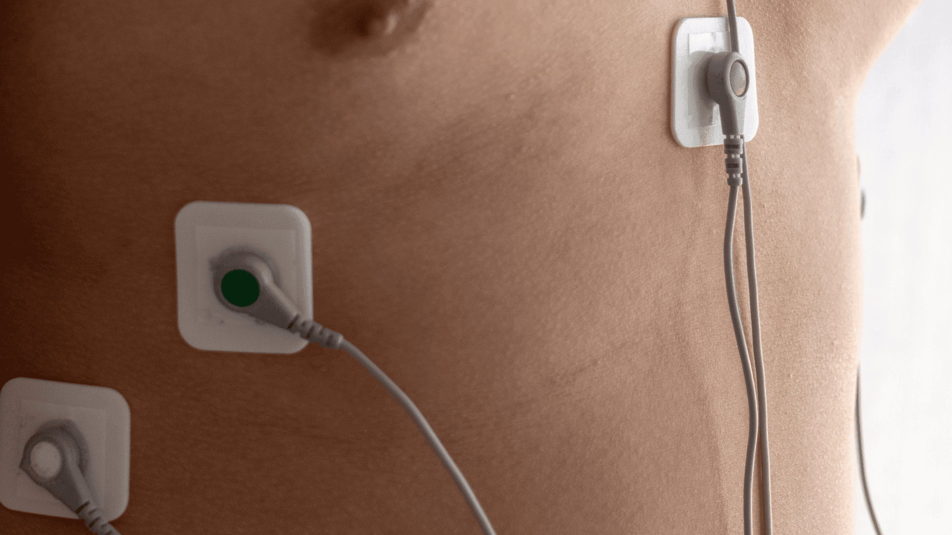 Torace di un paziente con elettrodi adesivi e cavi grigi dell’Holter cardiaco